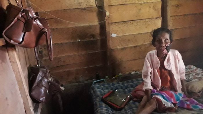Derita Nenek Mastia Pakpahan, Wajahnya Hancur Digerogoti Penyakit Ganas